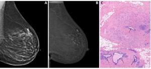 Can Contrast-Enhanced Mammography Offer a Viable Option for Pre-Op Assessment of Pathologic Nipple Involvement?