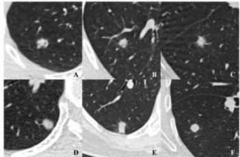 Can Density Homogeneity on Chest CT Improve Differentiation of Sub-Centimeter Nodules?