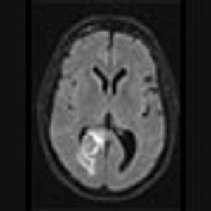 Image IQ: 73-year-old with History of Lung Mass Suffers Headaches