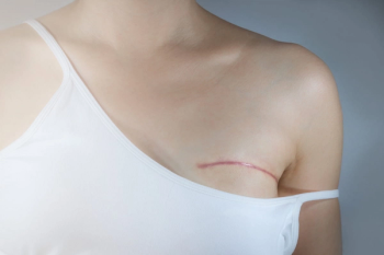 Study: Hypofractionated Radiation Regimen is Equivalent to Conventional Radiation Course in Women with Post-Mastectomy Breast Reconstruction
