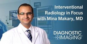 Interventional Radiology in Focus: A Closer Look at Y90 Radioembolization for Patients with Liver Cancer
