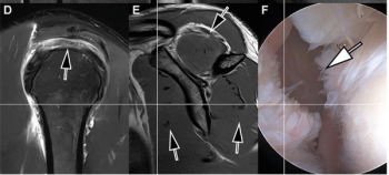Study Assesses Potential of Seven-Minute AI-Enhanced 3T MRI of the Shoulder