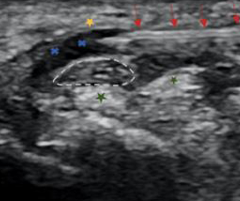L’hydrodissection guidée par ultrasons pourrait-elle être une alternative viable pour le syndrome du canal carpien ?