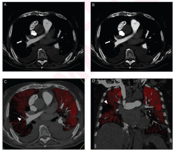 Is Photon Counting CT a More Viable Option than Dual-Energy CT for Pulmonary Angiography?