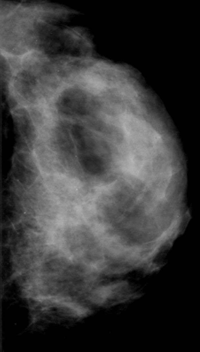 Cephalohematoma Cephalohematoma
