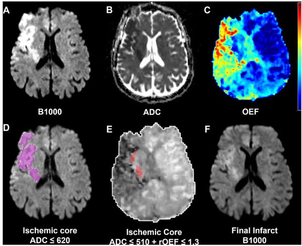 Can DSC MRI-Derived Oxygen Ejection Fraction Predict Diffusion Reversal in Patients Treated for Acute Ischemic Stroke?