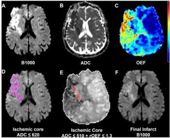 Can DSC MRI-Derived Oxygen Ejection Fraction Predict Diffusion Reversal in Patients Treated for Acute Ischemic Stroke?