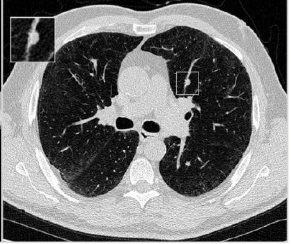 Emerging AI CT Tool May Provide Viable Complement to Lung-RADS Classification