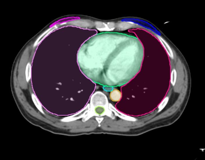 FDA Clears Update of AI-Enabled Imaging Contour Models