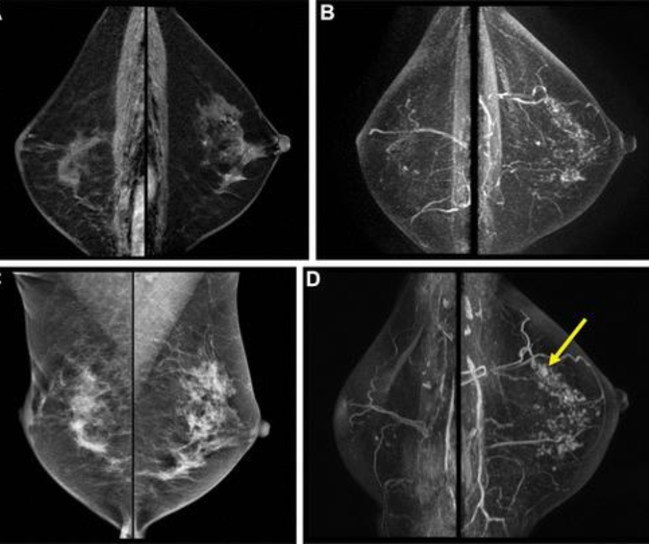 Surveillance MRI Study Shows Link Between Background Parenchymal Enhancement and Higher Risk of Second Breast Cancer