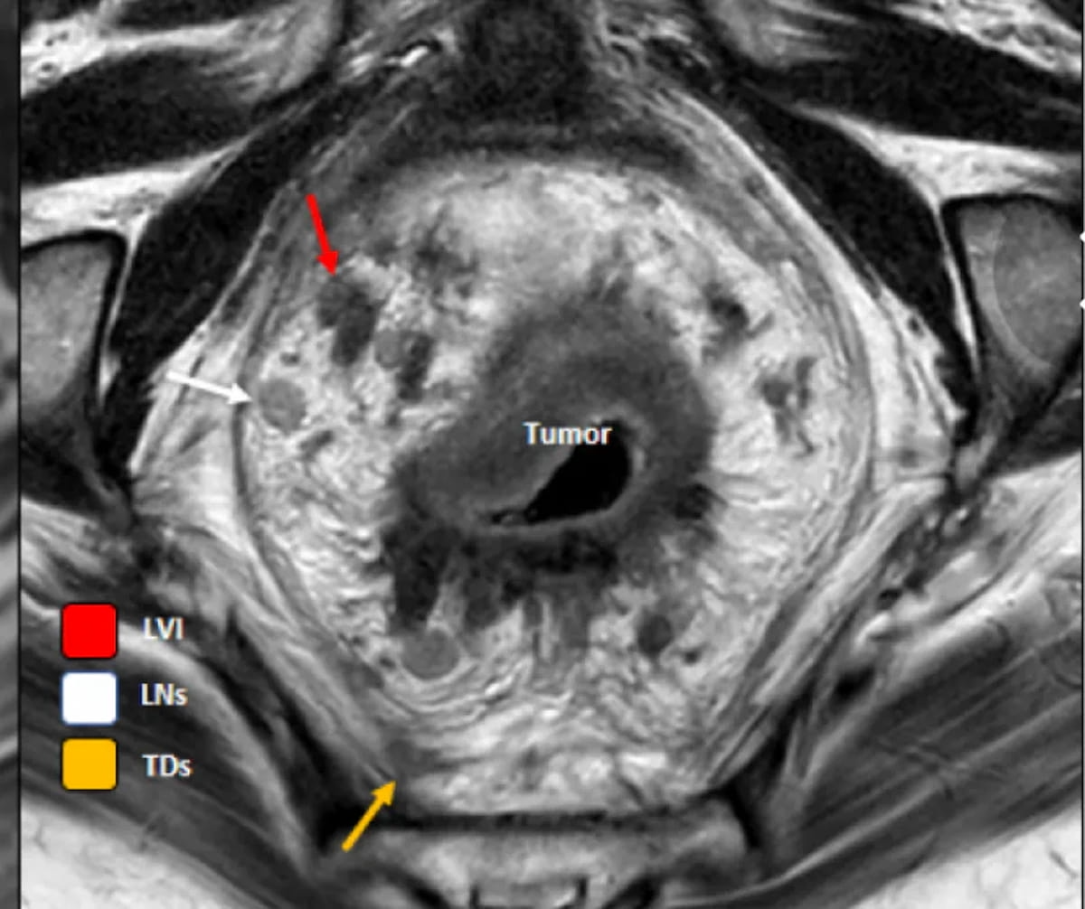 Study Finds Questionable Adherence to Guidelines for Rectal MRI