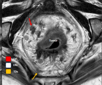 Study Finds Questionable Adherence to Guidelines for Rectal MRI