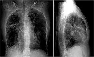 Allergic Broncho-Pulmonary Aspergillosis 