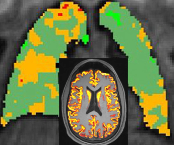 MRI Long Covid Study Reveals Link Between Lower Pulmonary Gas Exchange and Cognitive Dysfunction