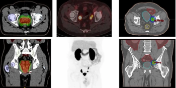 Emerging PET/CT Agent Shows Promise in Detecting PCa Recurrence in Patients with Low PSA Levels