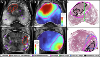 Study Says AI Mapping More Effective than MRI for Assessing Extent of Prostate Cancer