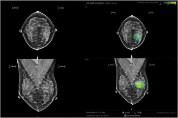 Multicenter Mammography Study Shows Greater Than 10 Percent Increase in Breast Cancer Detection with Adjunctive AI