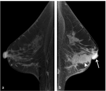 Predicting Nipple-Areolar Complex Involvement in Early-Stage Breast Cancer: Can Cone-Beam CT Have an Impact?