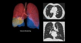 FDA Clears True Definition Deep Learning Software for High-Resolution CT Imaging
