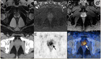 Study: PET/CT Multivariate Model Enhances Accuracy for Diagnosing Prostate Cancer 