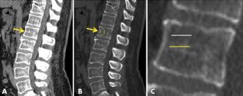 Threshold Values on CT Scans Help Identify Osteoporosis Opportunistically
