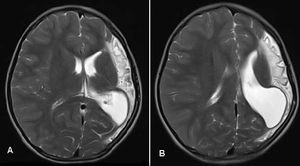 Dyke-Davidoff-Masson Syndrome Case 2