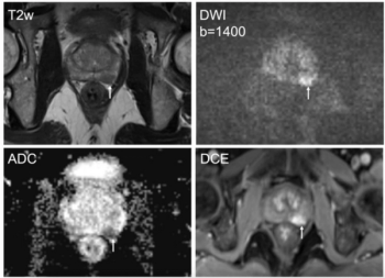 Emerging Predictive Model with mpMRI Findings May Reduce Up to 43 Percent of Unnecessary Systematic Prostate Biopsies