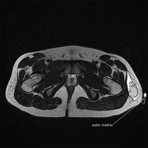 Fibrolipoma