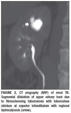 Multislice CT urography characterizes renal TB