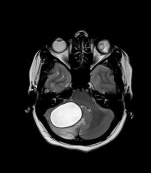 Von Hippel-Lindau Syndrome