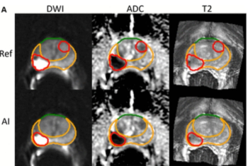 AI Segmentation, Intraprostatic Tumor Volume and Metastases: What a New mpMRI Study Reveals