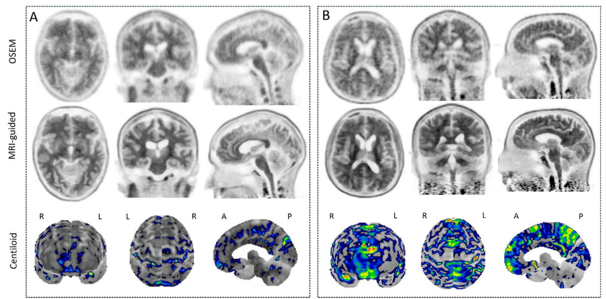Can MRI-Guided Reconstruction Improve Assessment of Amyloid Brain PET Scans?