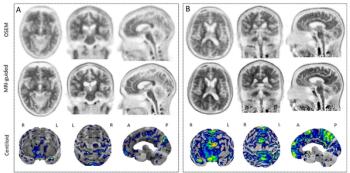 Can MRI-Guided Reconstruction Improve Assessment of Amyloid Brain PET Scans?