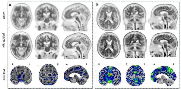 Can MRI-Guided Reconstruction Improve Assessment of Amyloid Brain PET Scans?