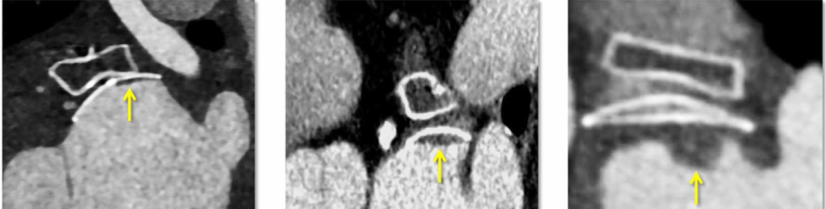 What a New CT Study Reveals About Hypoattenuation Thickening After Left Atrial Appendage Occlusion (LAAO) Procedures 