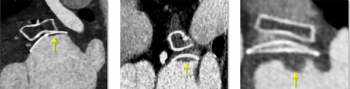 What a New CT Study Reveals About Hypoattenuation Thickening After Left Atrial Appendage Occlusion (LAAO) Procedures