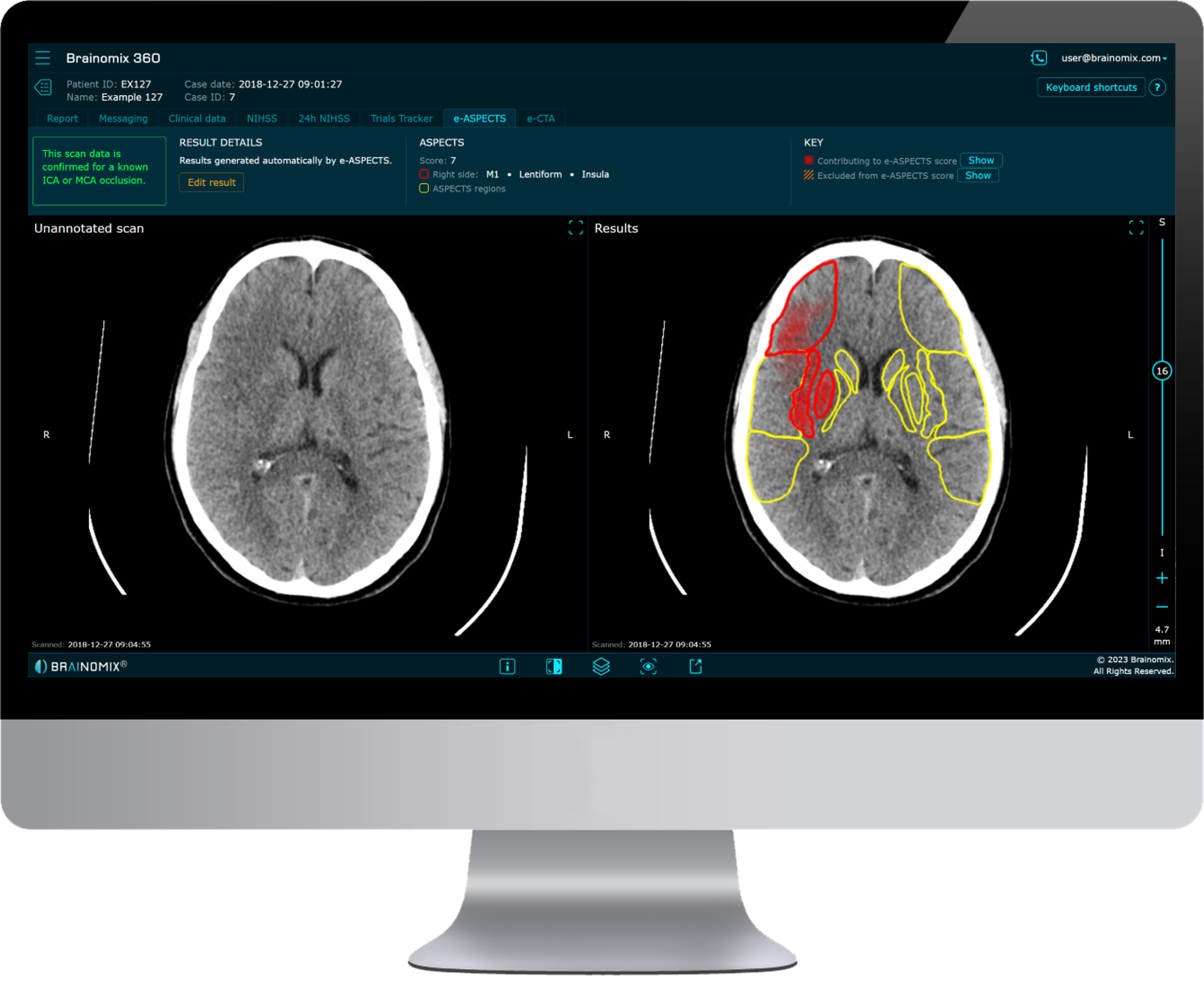 FDA Clears AIPowered Stroke Imaging Tool for NonContrast CT