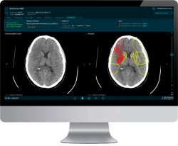 FDA Clears AI-Powered Stroke Imaging Tool for Non-Contrast CT