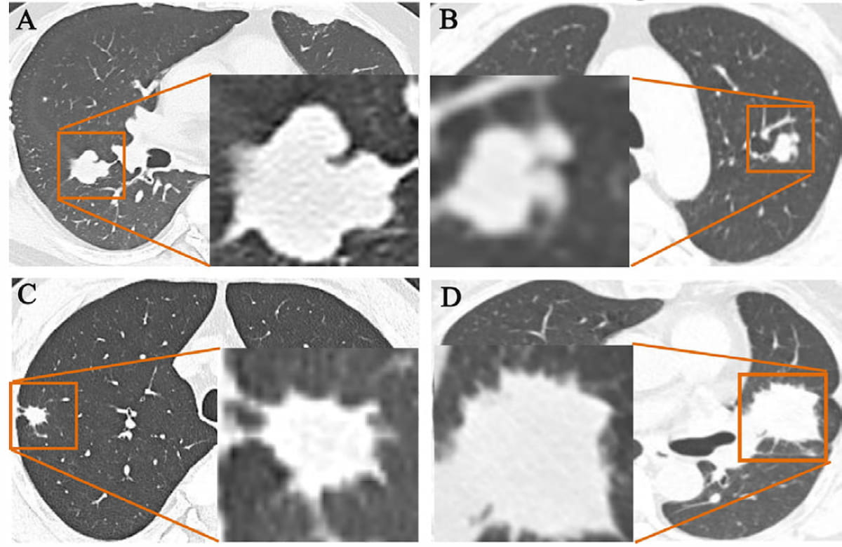 Study: PCCT Facilitates Superior SNR and CNR in Lung Cancer Imaging with 55 Percent Reduction in Radiation Dosing