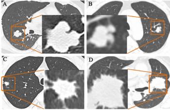 Study: PCCT Facilitates Superior SNR and CNR in Lung Cancer Imaging with 55 Percent Reduction in Radiation Dosing