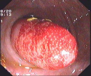 Appendiceal Intussusception into Cecum 