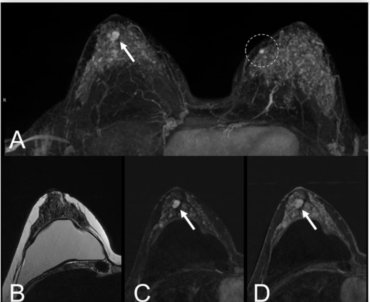 New Breast MRI Study Says Background Parenchymal Enhancement Has No Impact on Lesion Detection