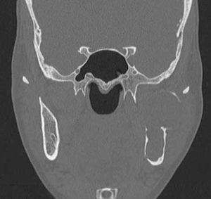 Gorlin-Goltz Syndrome