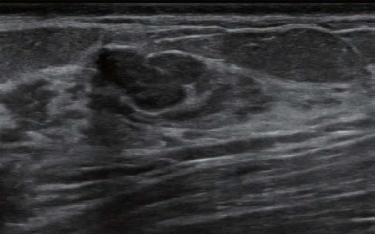 Multicenter Breast Ultrasound Study: AI Bolsters Accuracy and Specificity of BI-RADS Classifications