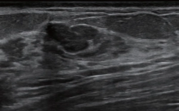 Multicenter Breast Ultrasound Study: AI Bolsters Accuracy and Specificity of BI-RADS Classifications