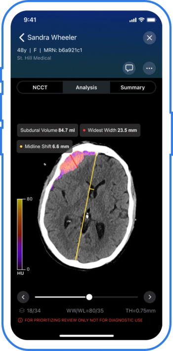 FDA Clears CT-Based AI Software for Subdural Collections