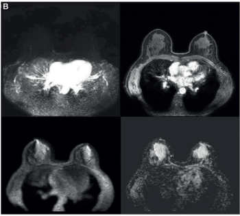 Study: Abbreviated Breast MRI Offers Equivalent Accuracy to mpMRI for Women with Dense Breasts