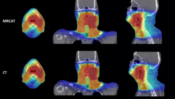 Philips Gets FDA Nod for MRI Head and Neck Radiotherapy Application