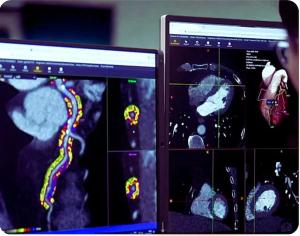 FDA Grants De Novo Authorization for AI-Based Coronary Inflammation Quantification from CCTA Exams