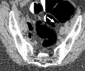 A Victory for Radiology: New CMS Proposal Would Provide Coverage of CT Colonography in 2025
